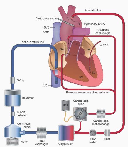 centrifugal pump cardiopulmonary bypass|basics of cardiopulmonary bypass.